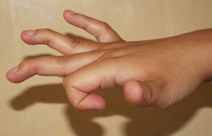 Hypermobil hand 1.jpg